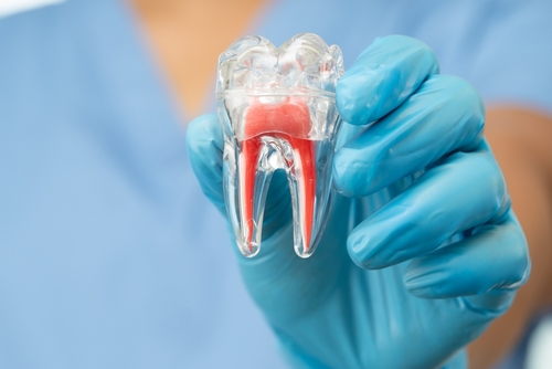 root canal treatment