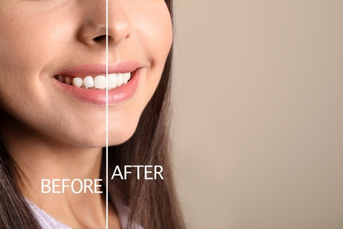 Minimally Invasive Gum Grafting Options in Beverly Hills
