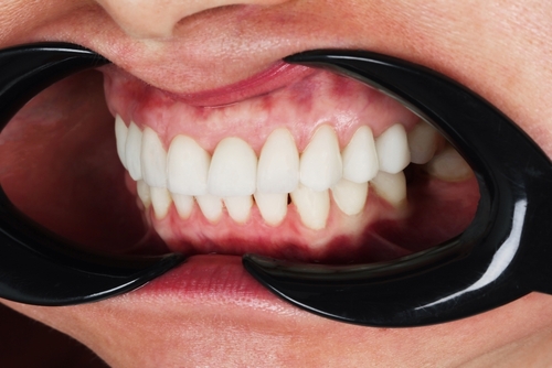 Oral Cancer Screening